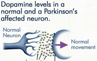 Gulf Weekly Treating Parkinson’s