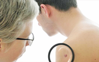 Gulf Weekly Moles on right arm linked to skin cancer